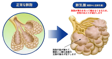 肺気腫